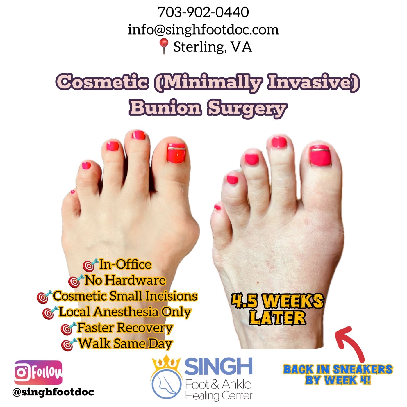 MIFAS Before and After Cosmetic Bunion Surgery