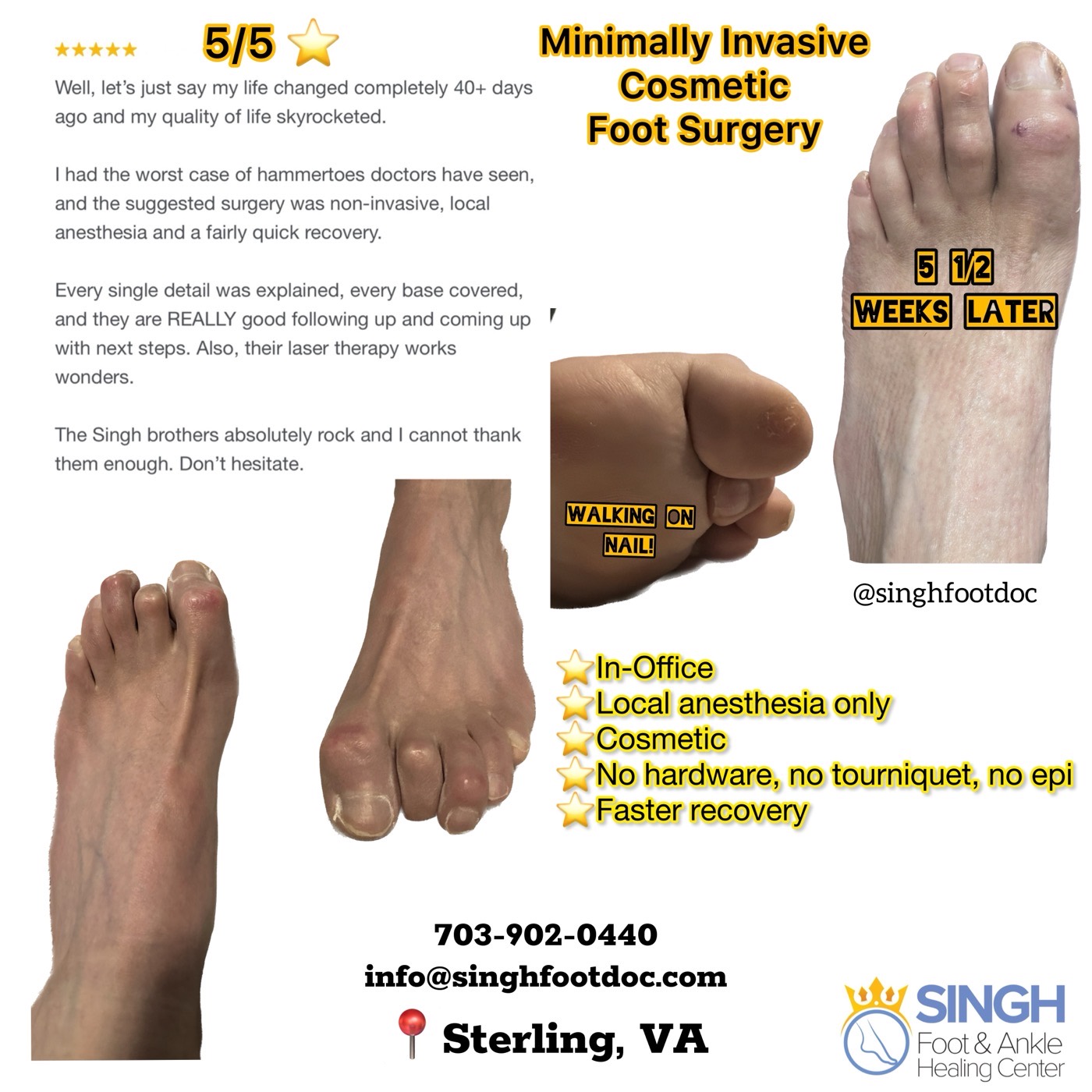 MIFAS Another Example Cosmetic Bunion Surgery