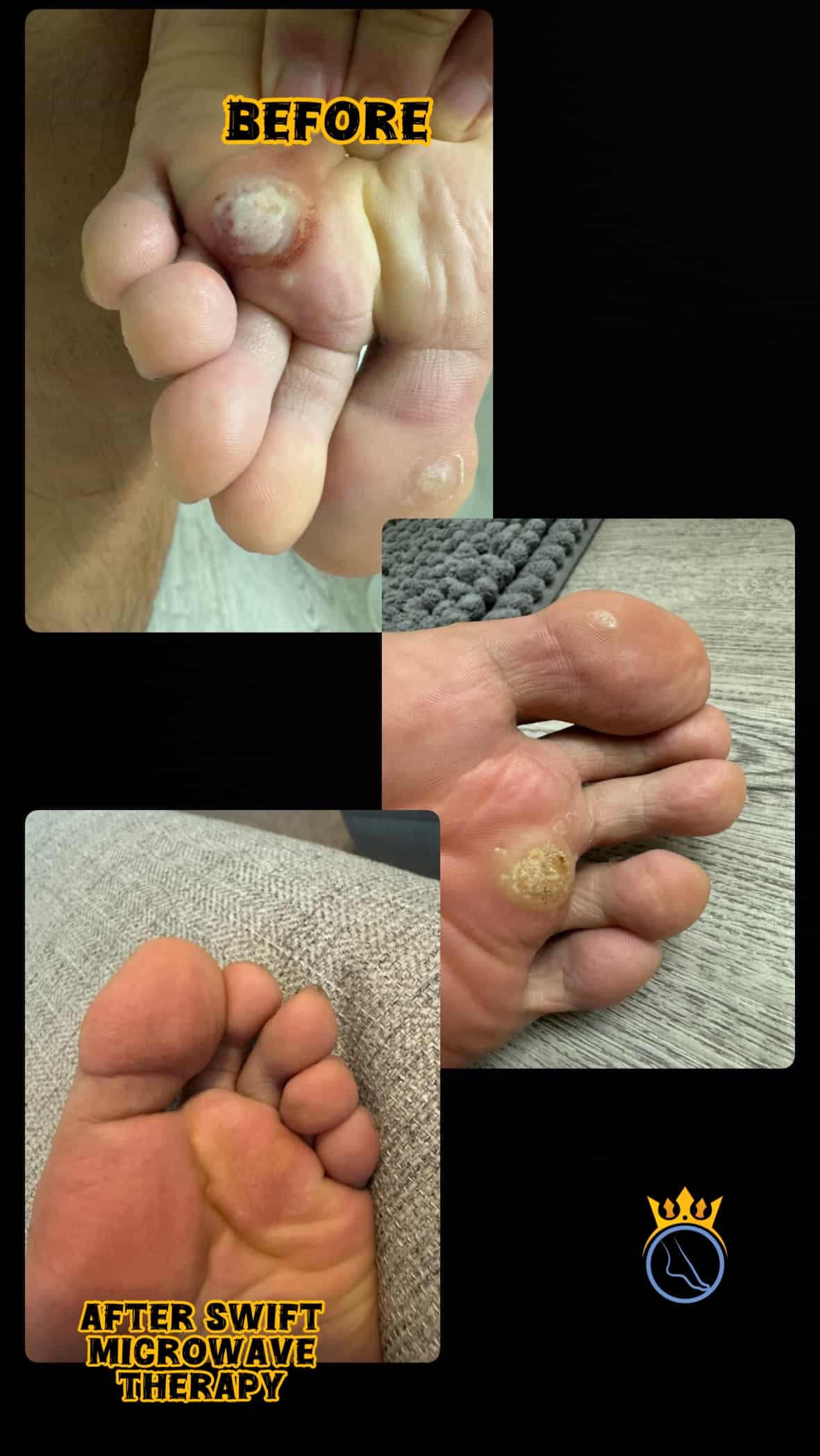 SWIFT Treatment Final Result